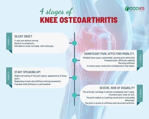 KNEE OSTEOARTHRITIS – WHICH STAGE ARE YOU IN?