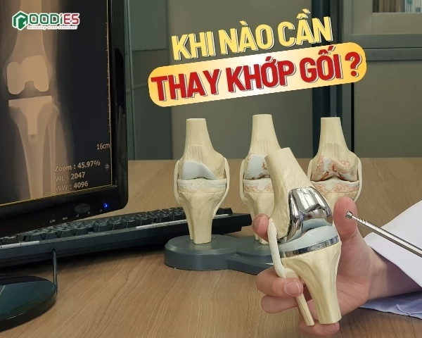 KHI NÀO CẦN THAY KHỚP GỐI? ĐỪNG ĐỂ ĐAU ĐẾN MỨC KHÔNG CHỊU NỔI!