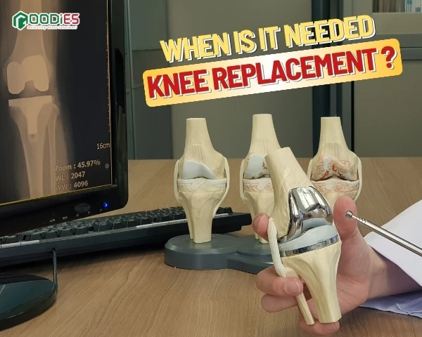 WHEN DO YOU NEED A KNEE REPLACEMENT? DON’T WAIT UNTIL THE PAIN BECOMES UNBEARABLE!