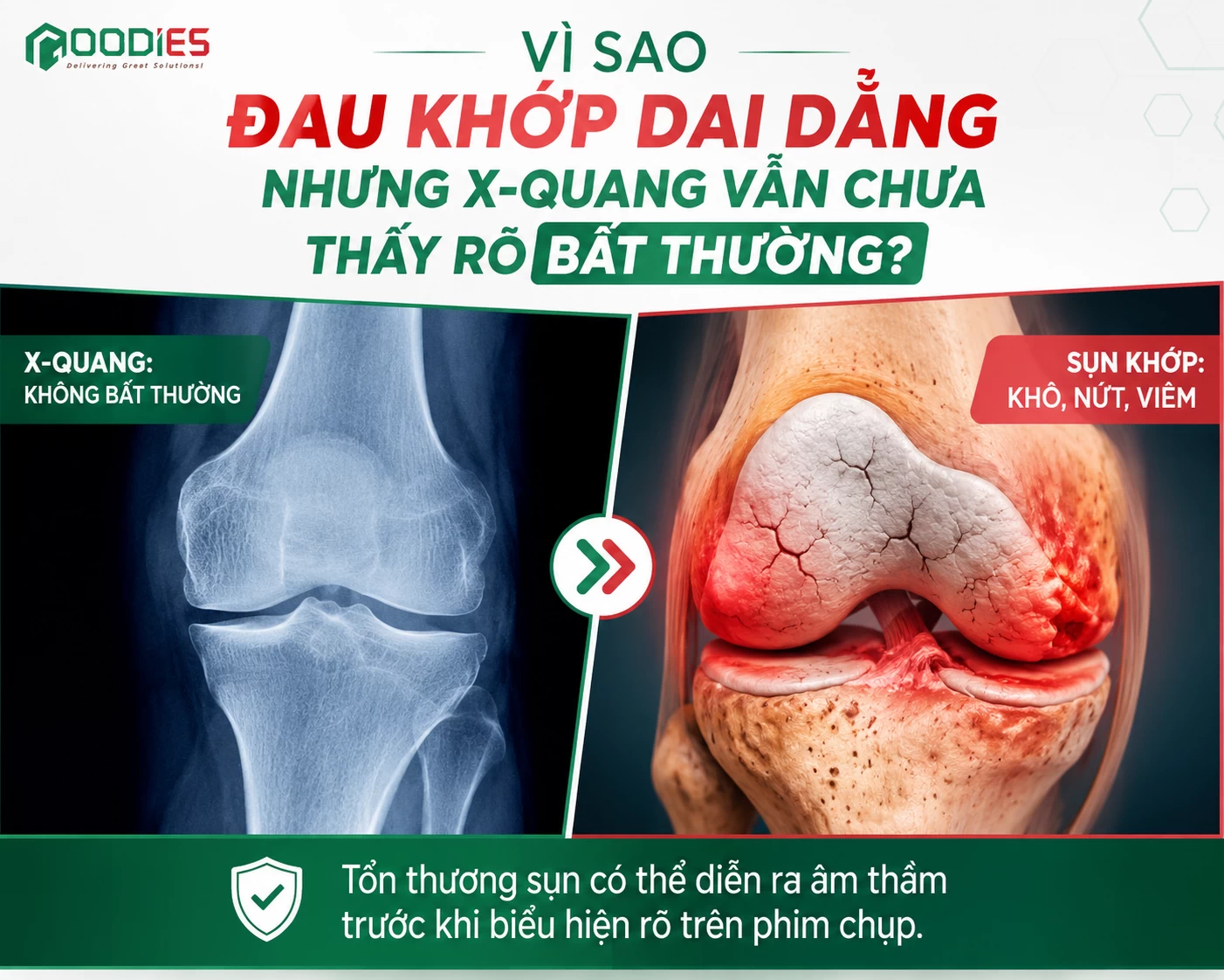 ĐAU KHỚP KÉO DÀI NHƯNG X-QUANG “CHƯA NẶNG” – VÌ SAO VẪN ĐAU NHIỀU?