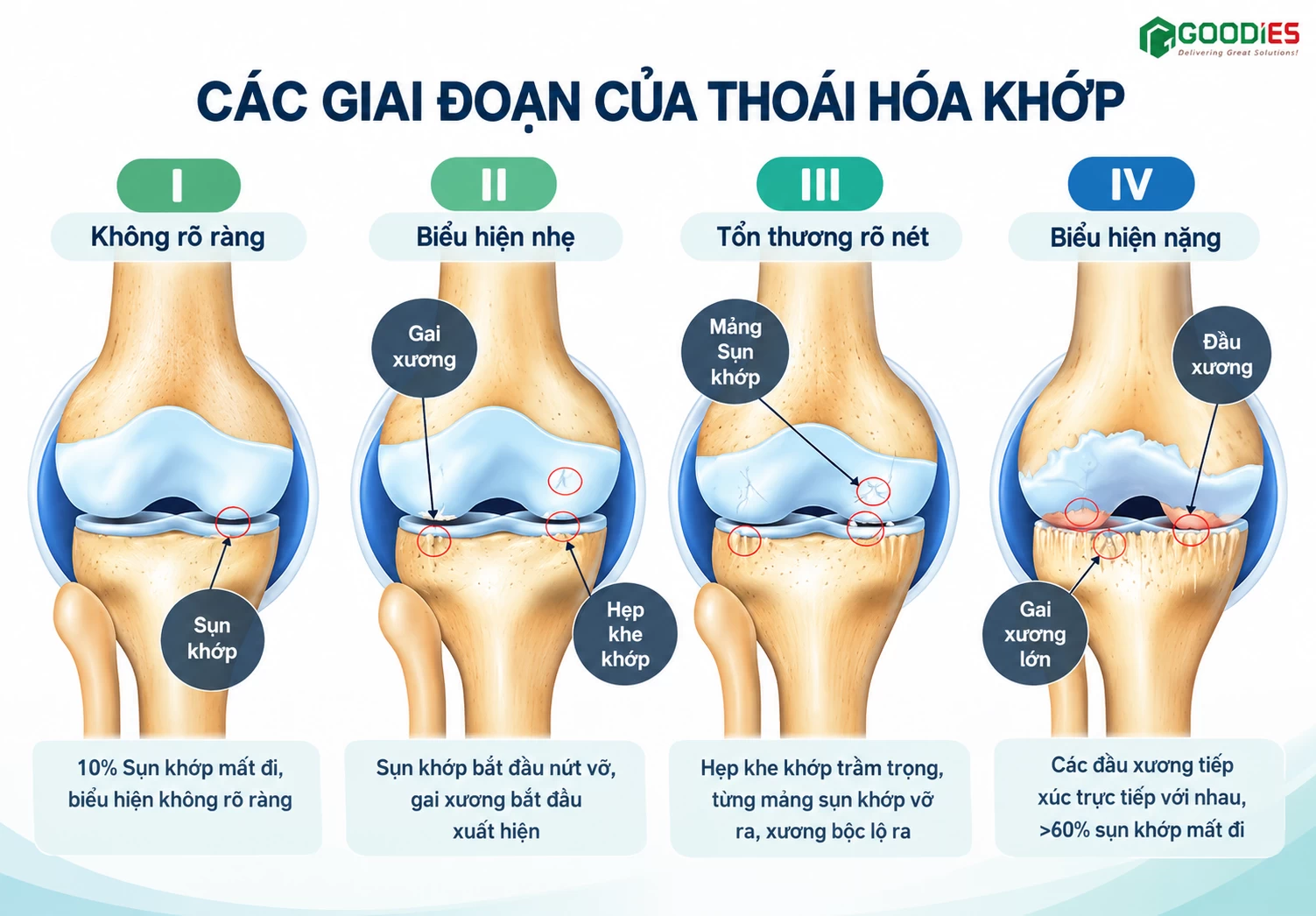 THOÁI HÓA KHỚP GỐI TIẾN TRIỂN QUA 4 GIAI ĐOẠN NHƯ THẾ NÀO?